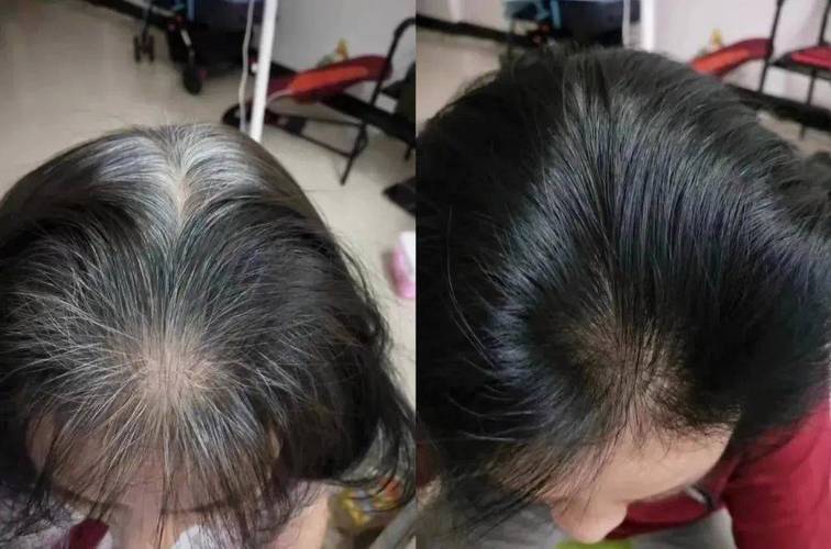 央视曝光!这些黑发产品无效还有害!白发生得多、生得早,根本原因是这个