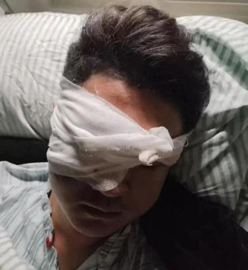 突发！1.5米长伞骨 直刺江西一男子眼部